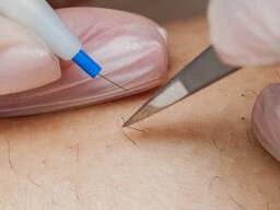 Электроэпиляция Торревьеха Испания